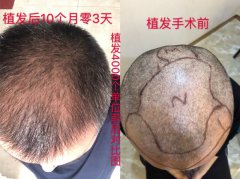 北京博士园植发失败，但不能挽救！植发后我还用了博士园干细胞