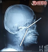 成功救治一名两根十厘米铁钉刺入头部患者