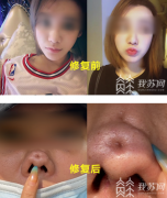 女子在南京智颜整形做隆鼻修复 ，结果面目全非不能见人！